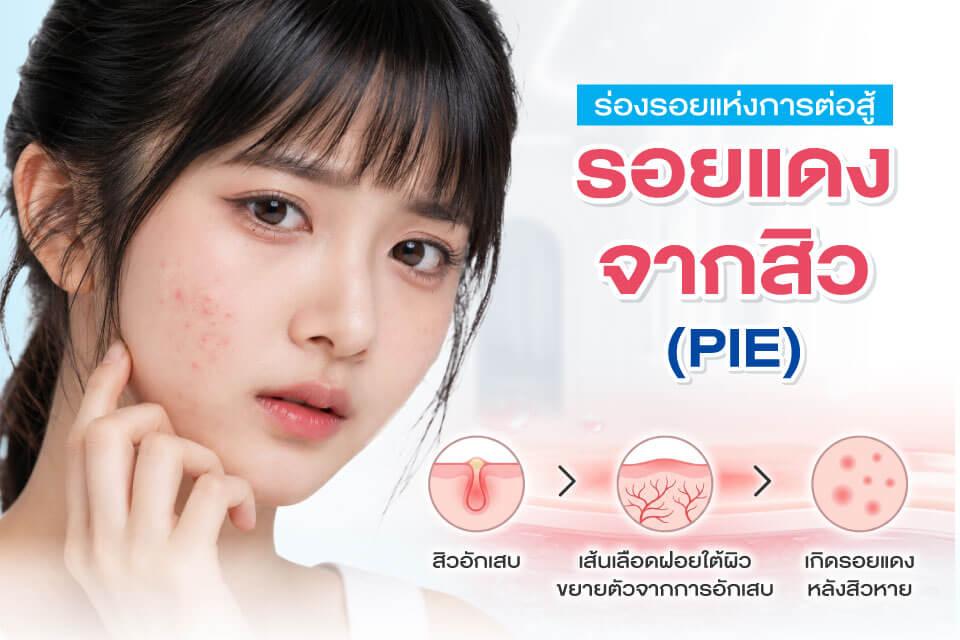สิว รอยดำ รอยแดง ต่างกันอย่างไร? ดูแลแบบไหนถึงเห็นผล