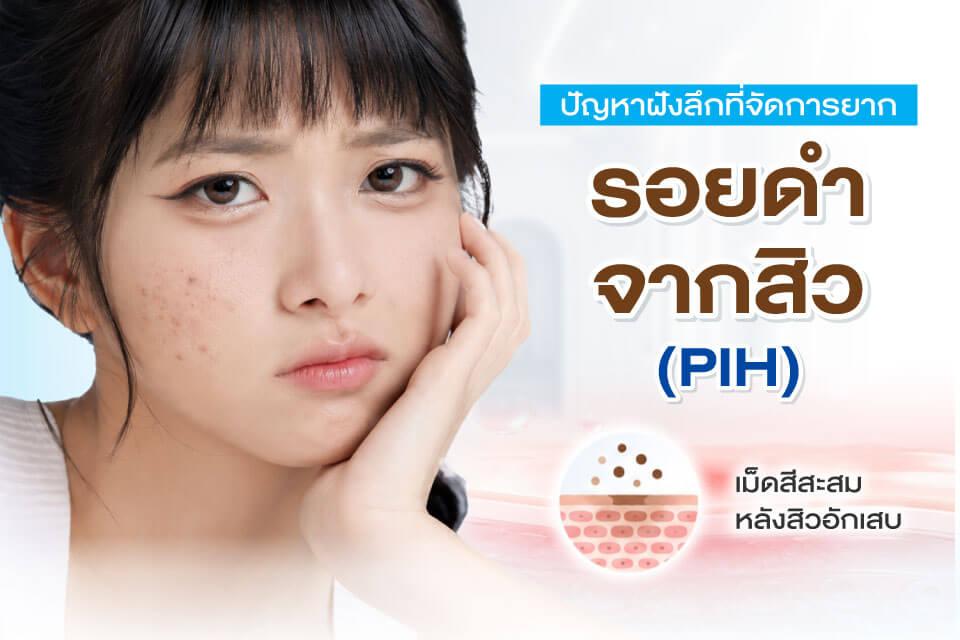สิว รอยดำ รอยแดง ต่างกันอย่างไร? ดูแลแบบไหนถึงเห็นผล
