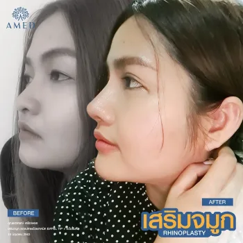 เสริมจมูก