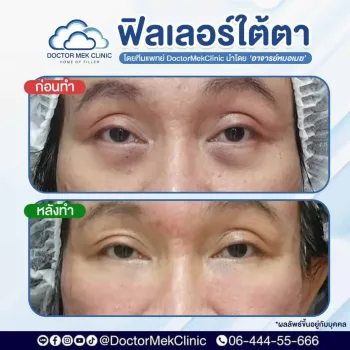 ฉีดฟิลเลอร์