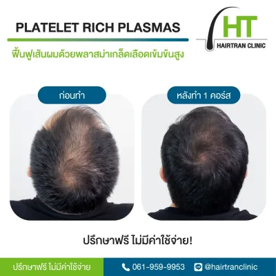 Before and after hair root stimulation injection treatment by Hairtran Clinic