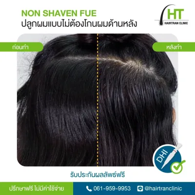 Before and after Non-Shaven FUE hair transplant by Hairtran Clinic
