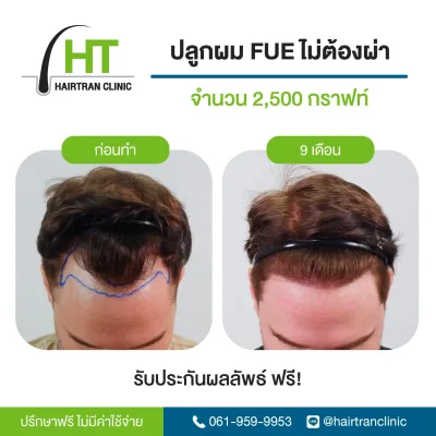 ภาพก่อนและหลังการศัลยกรรมปลูกผมแบบ FUE โดย Hairtran Clinic