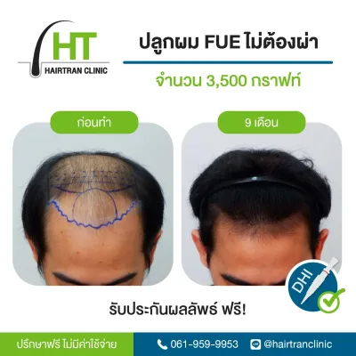 ภาพก่อนและหลังการศัลยกรรมปลูกผมแบบ FUE โดย Hairtran Clinic