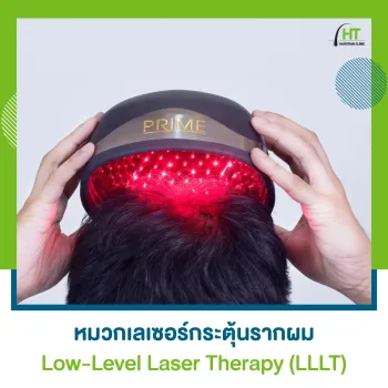 ปลูกผมด้วย Low-Level Laser Therapy