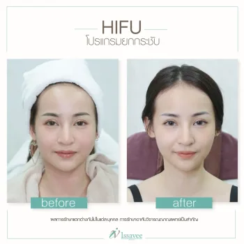 Hifu