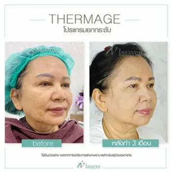 Thermage