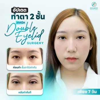 ทำตา 2 ชั้น