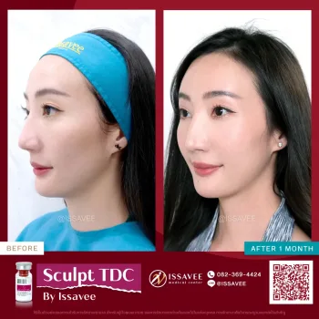 Sculptra