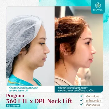 ดูดไขมัน FTL 360 Liposuction