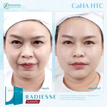 โปรแกรม Radiesse