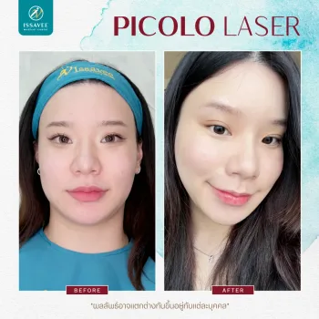 PICO Laser