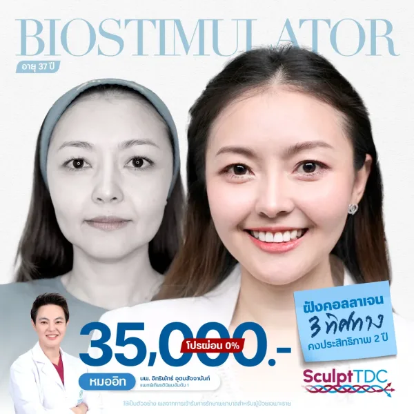 รายละเอียดโปรโมชั่นฝังคอลลาเจน Issavee Clinic