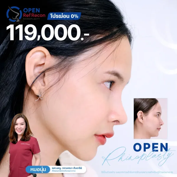 รายละเอียดโปรโมชั่นเสริมจมูก Issavee Clinic