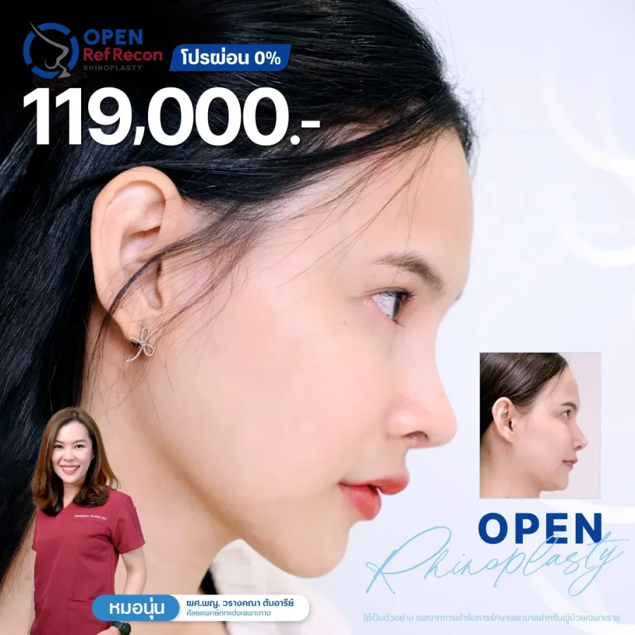 รายละเอียดโปรโมชั่นเสริมจมูก Issavee Clinic