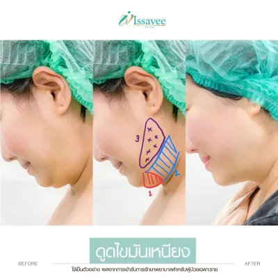 Before and after double chin liposuction