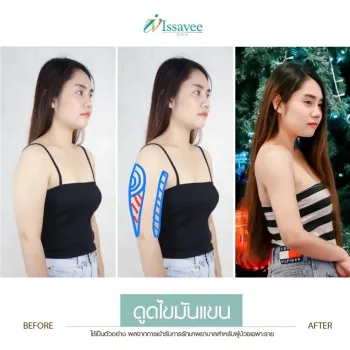 Liposuction