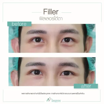 Filler