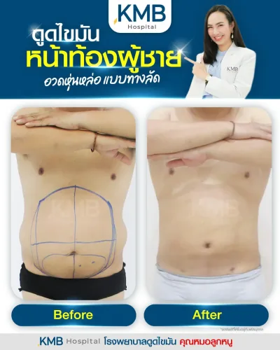 Before and after abdominal liposuction