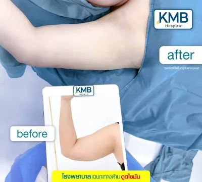 Before and after upper arm liposuction