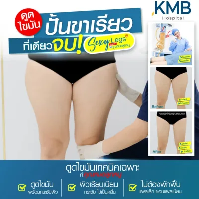 ผลการรักษาก่อนและหลังดูดไขมันต้นขา