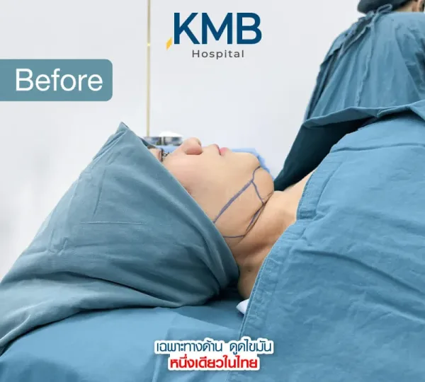 ก่อน - Before and after double chin liposuction