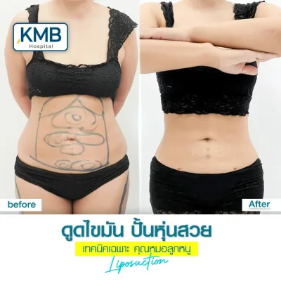 ผลการรักษาก่อนและหลังดูดไขมันหน้าท้อง