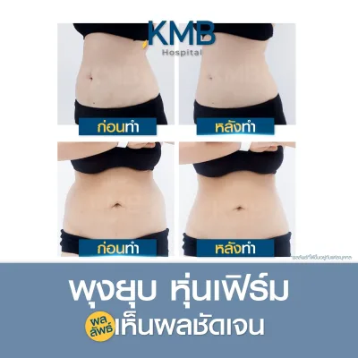 ผลการรักษาก่อนและหลังดูดไขมันหน้าท้อง