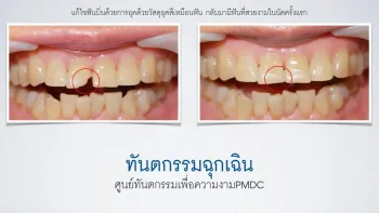 ฟันแตก ฟันหัก ครอบฟันหลุด