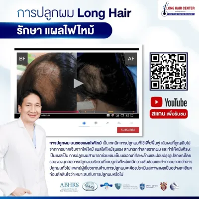 Before and after Long Hair transplant treating a burn scar