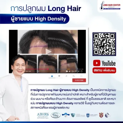 Before and after high-density Long Hair transplant for men