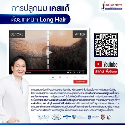 Before and after a corrective hair transplant using the Long Hair technique