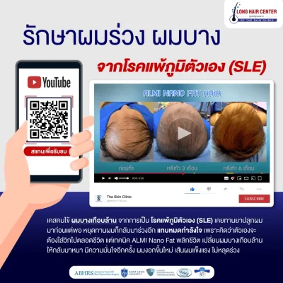 ภาพก่อนและหลังการเข้ารับการปลูกผมรักษาผมร่วง ผมบาง จากโรคภูมิแพ้ตัวเอง (SLE)