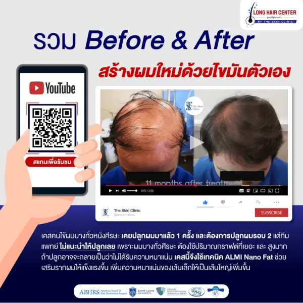 ก่อน - Before and after a hair transplant using the ALMI Nano Fat technique