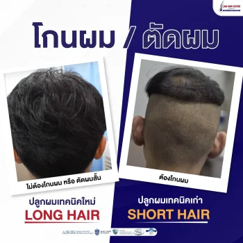 ปลูกผมยาวเทคนิค Long Hair FUI