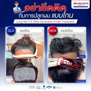 ปลูกผมแบบโกนผมเทคนิค FUI