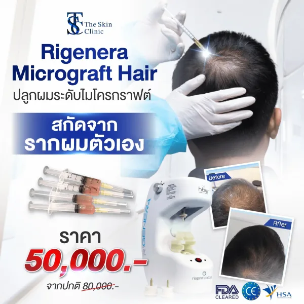 รายละเอียดโปรโมชั่น Rigenera Micrograft Hair ปลูกผมระดับไมโครกราฟต์