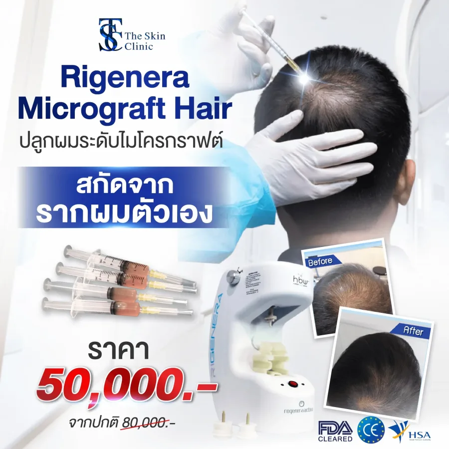 รายละเอียดโปรโมชั่น Rigenera Micrograft Hair ปลูกผมระดับไมโครกราฟต์