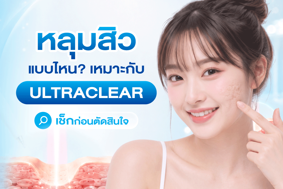 หลุมสิวแบบไหนเหมาะกับ UltraClear? เช็กก่อนตัดสินใจ