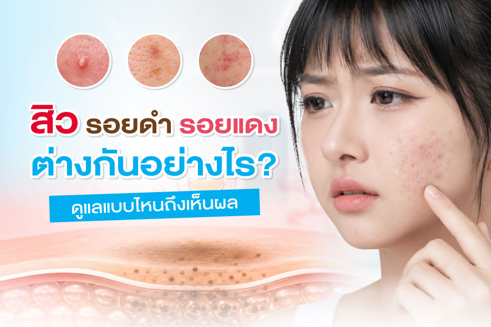สิว รอยดำ รอยแดง ต่างกันอย่างไร? ดูแลแบบไหนถึงเห็นผล