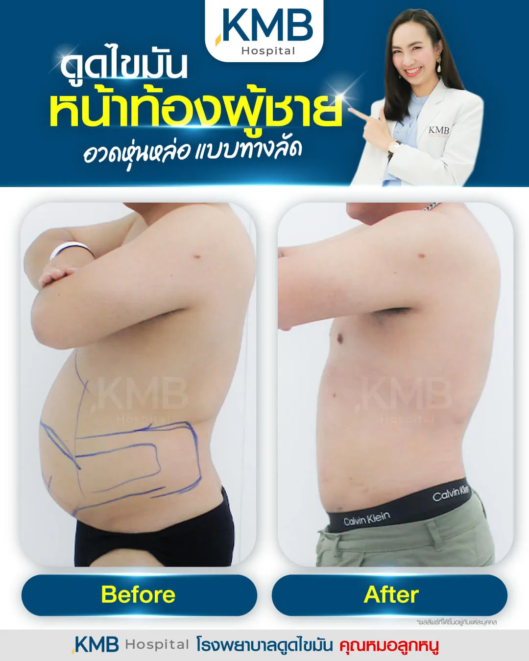 Before - Liposuction