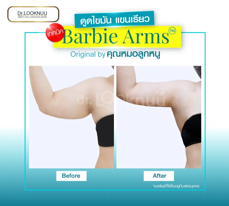 Before - Liposuction
