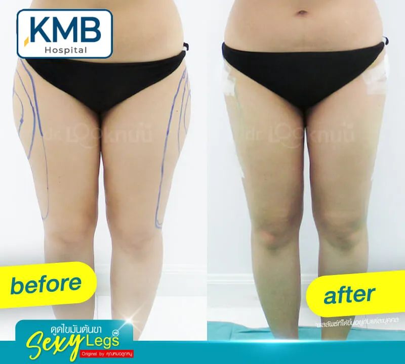 Before - Liposuction