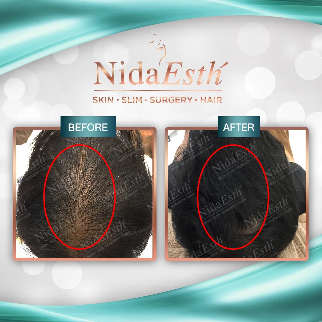 Before - Hair Transplant