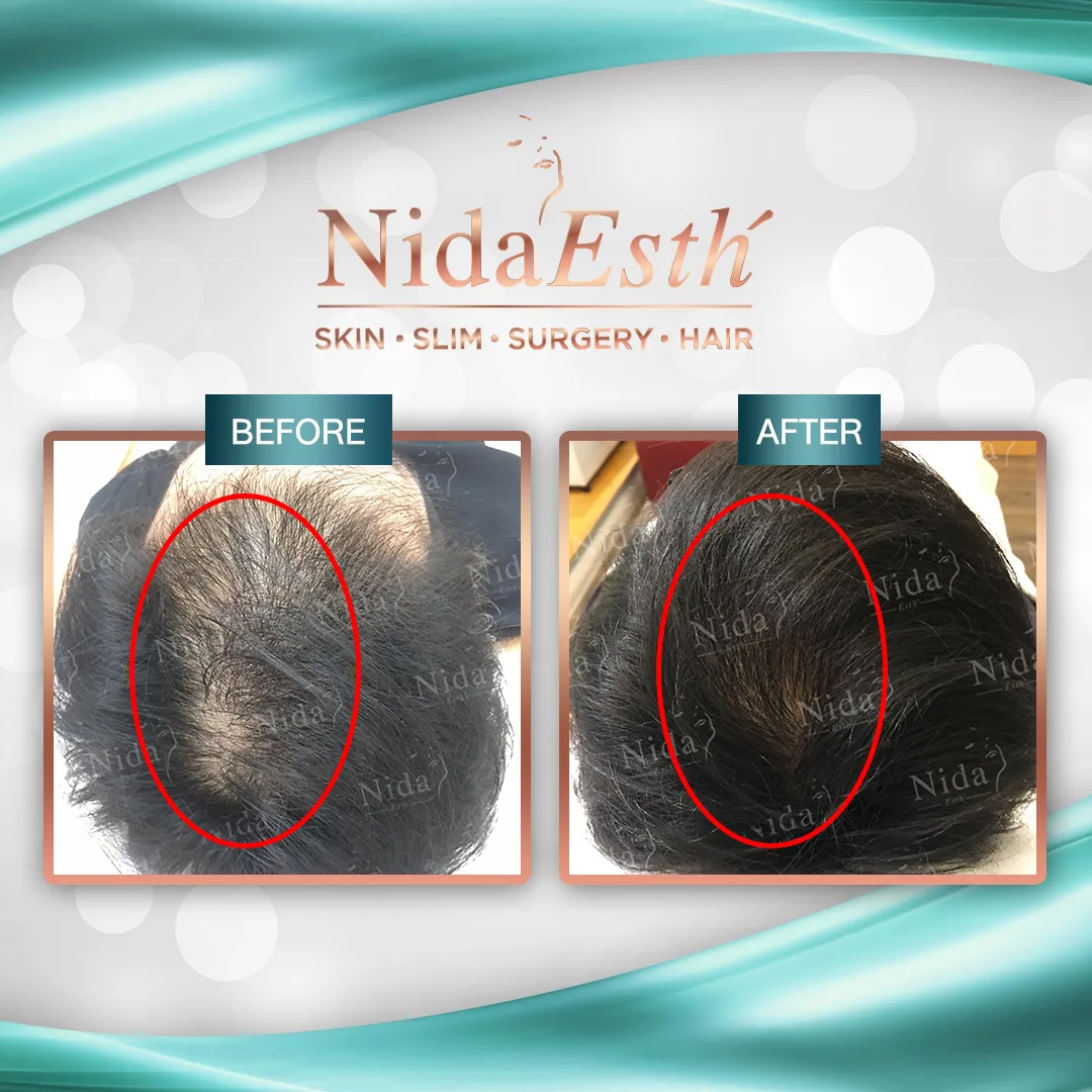 Before - Hair Transplant
