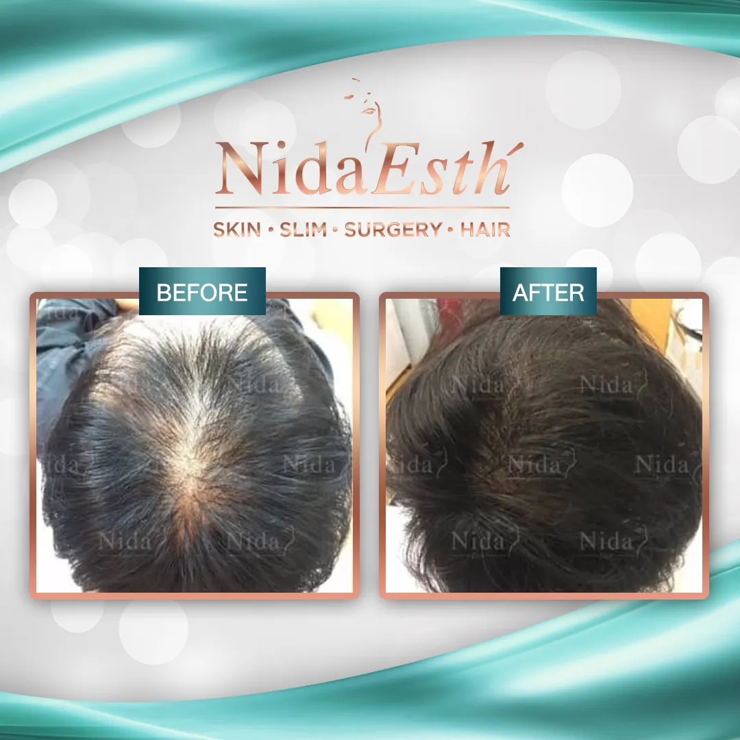 Before - Hair Transplant