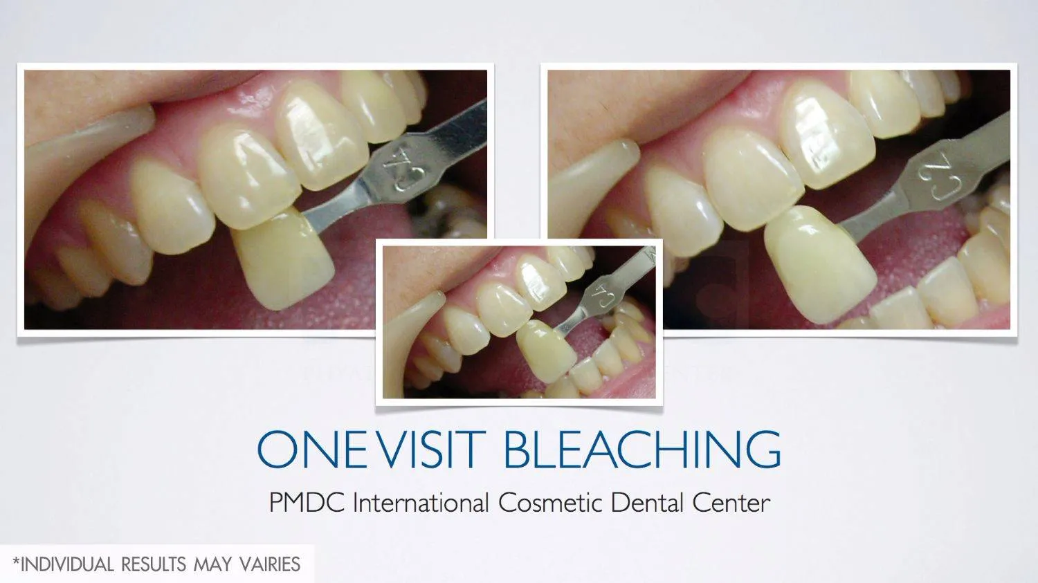 Before - Teeth Whitening