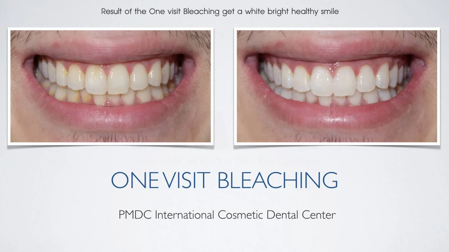 Before - Teeth Whitening