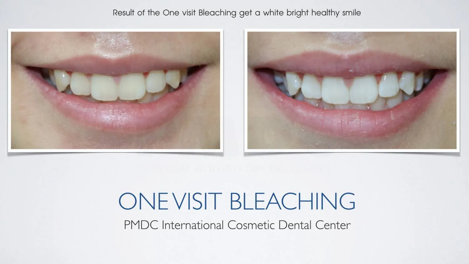 Before - Teeth Whitening