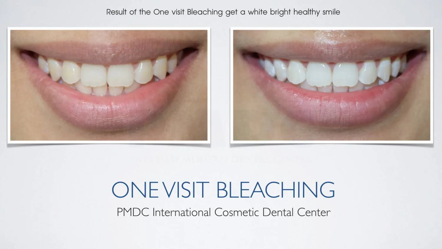 Before - Teeth Whitening